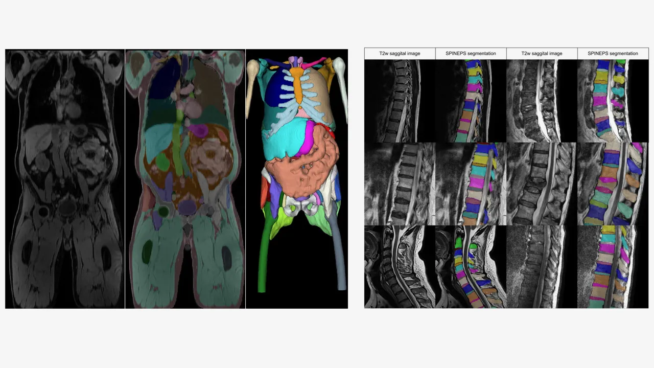 Deep learning segmentation of biomedical images: whole body segmentation (left) and spine segmentation from MR images (right)