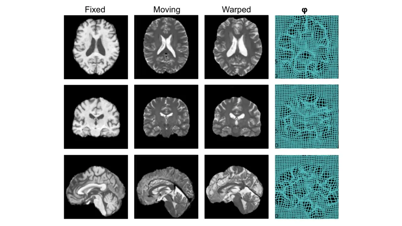 Registration of a pair of T1-weighted and T2-weighted brain MR images using implicit neural representation of deformation